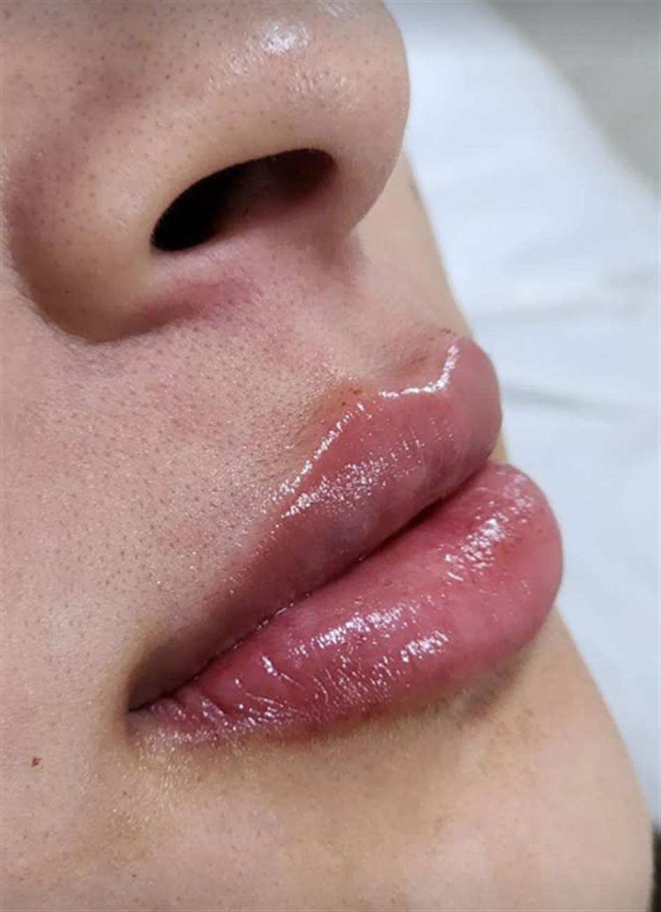 Resultado de hidragloss