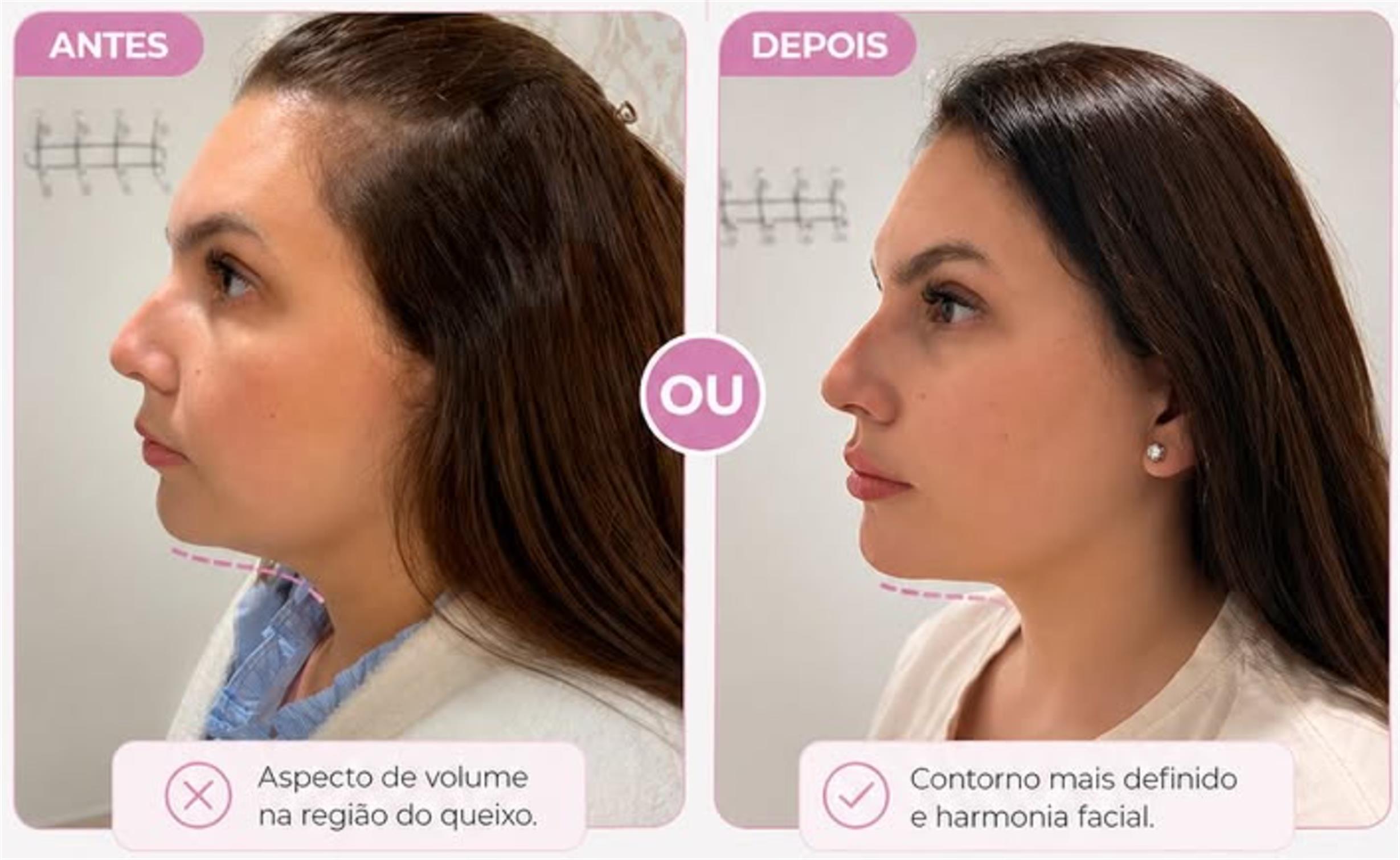 Antes e depois de contorno facial