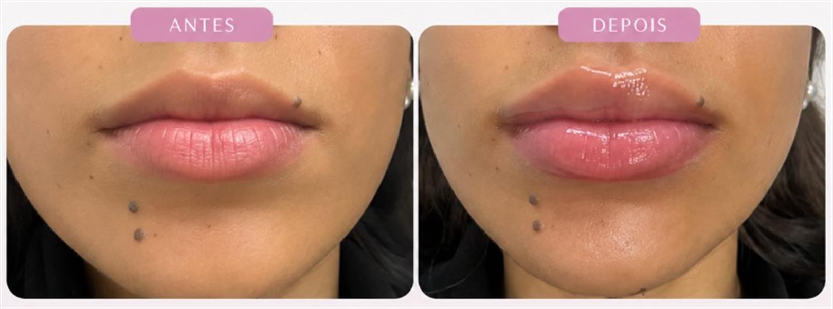 Antes e depois de hidratação labial