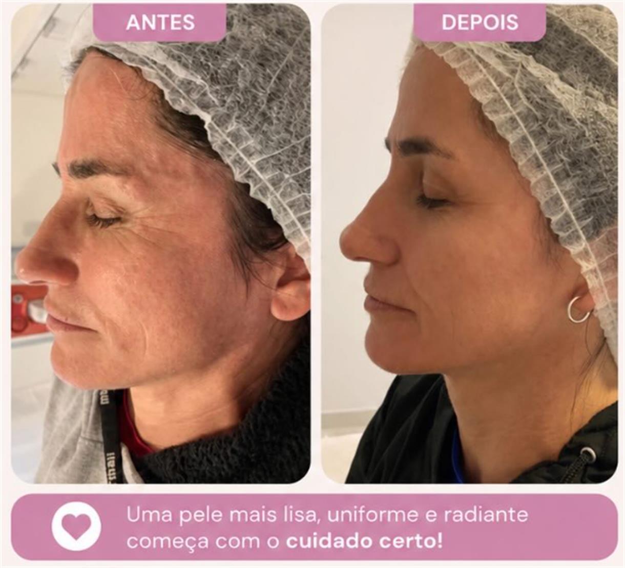 Antes e depois de tratamento de pele